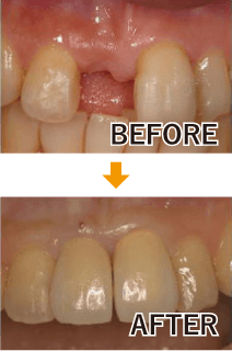 単独歯の治療例