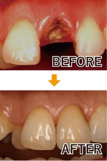 単独歯の治療例